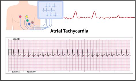 Atrial Tachycardia: Symptoms, Causes & Treatment .
